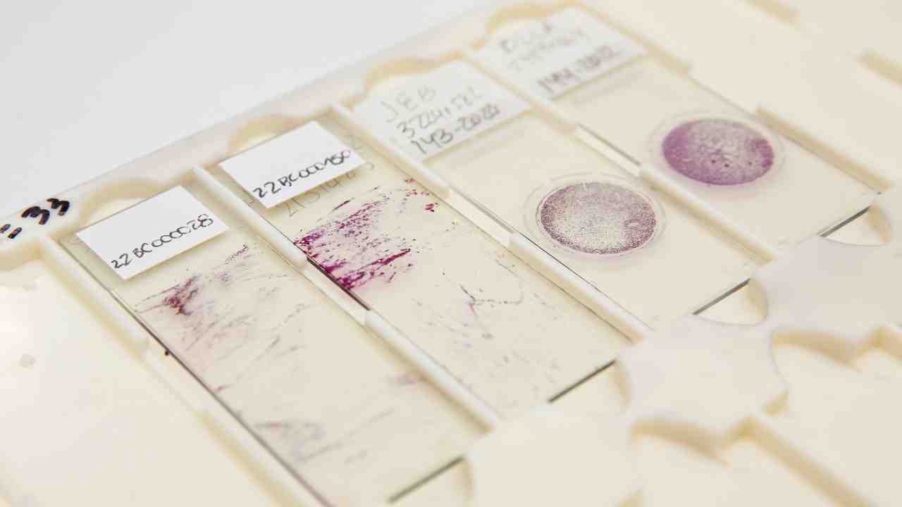 The Role of Brain Biopsy in Alzheimer’s Disease Diagnosis